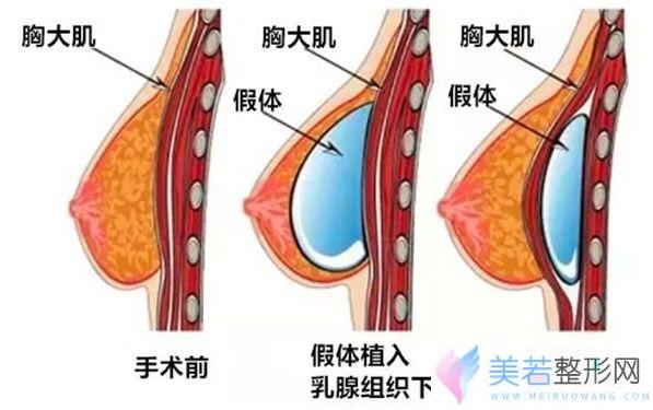 乳房假体植入层次