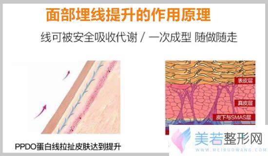 面部埋线提升的作用原理