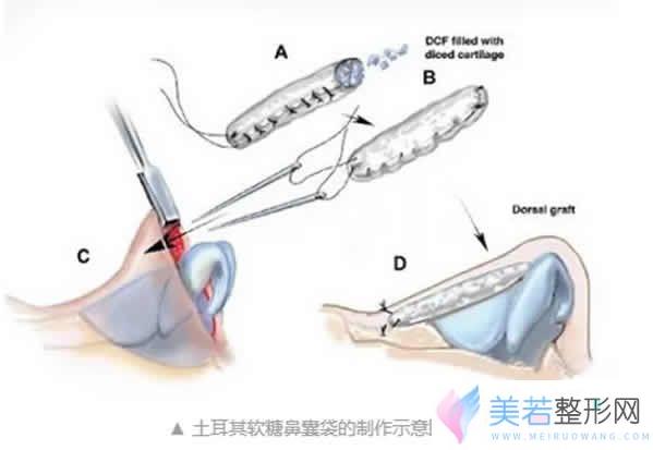 土耳其软糖隆鼻手术原理图解