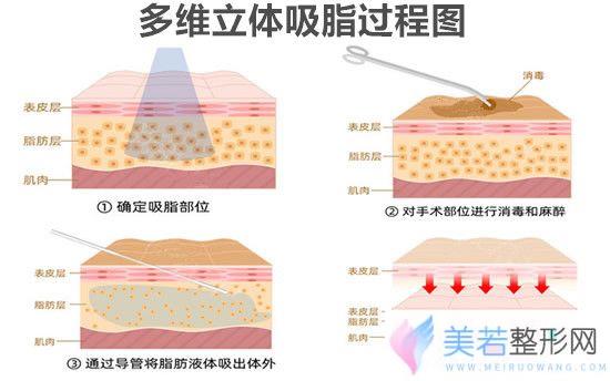 多维立体吸脂过程图