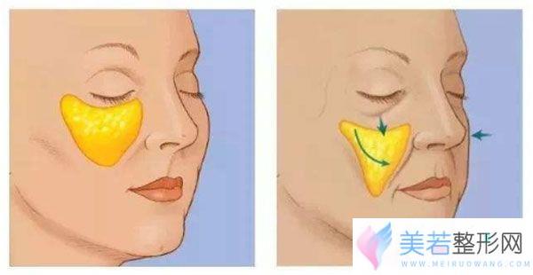 埋线提升后苹果肌变大、变鼓的原因