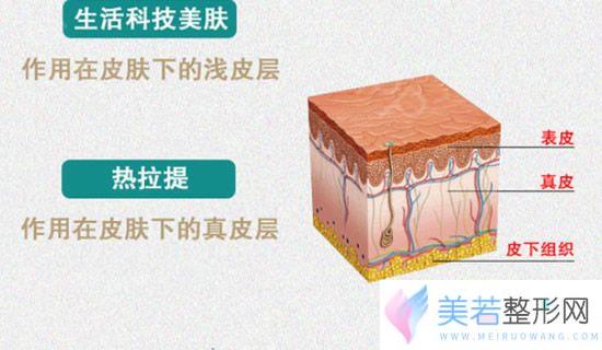 热拉提的作用原理