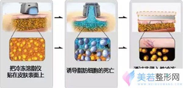 酷塑冷冻溶脂减肥果到底怎么样