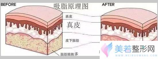 吸脂原理图