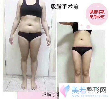 腰腹环吸三个月果图，腰围瘦了13cm