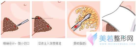 腰腹环吸抽脂手术原理示意图