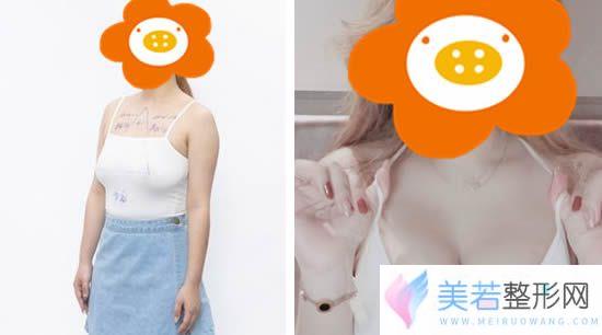 我做乳房下垂矫正前后对比图