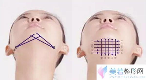 颈部、双下巴植入的线材位置