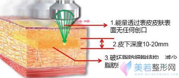 超声波溶脂一个月能做几次