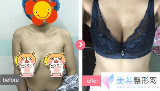 我做人工韧带乳房提升手术案例果