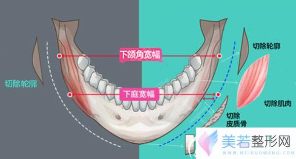 下颌骨手术切除的部位