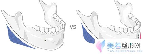 下颌角补骨，用人工骨做修复果怎么样