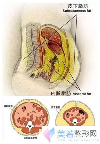 皮下脂肪和内脏脂肪的区别