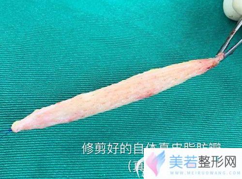 修剪好的皮瓣组织