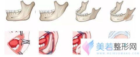 下颌角手术过程