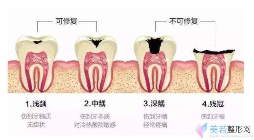 哪些牙根不需要拔