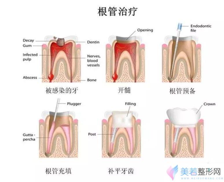 根管调节结束后才能补牙