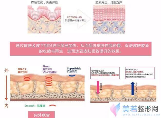 fotona  4d抗衰技术原理示意图