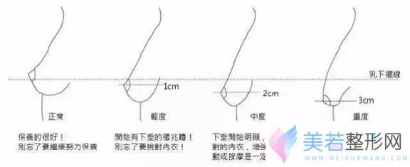 乳房下垂