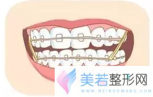 牙齿矫正