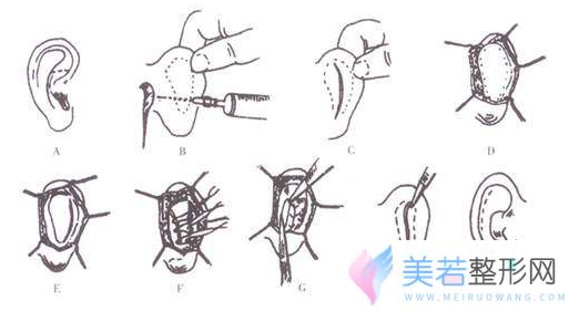 招风耳矫正