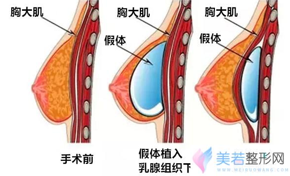 假体隆胸手术原理