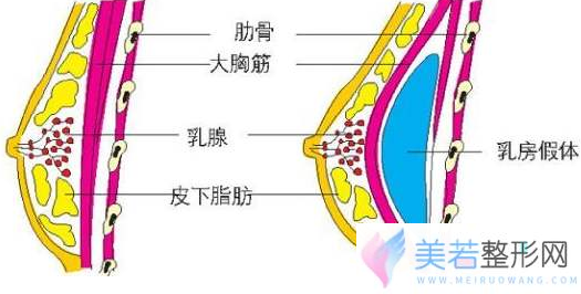 假体隆胸手术原理