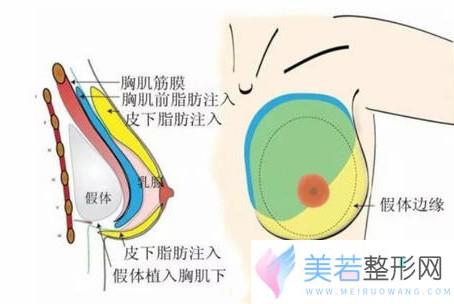 假体隆胸结合自体脂肪隆胸