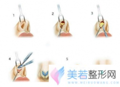 用膨体隆鼻好不好？