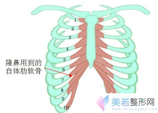 肋软骨隆鼻