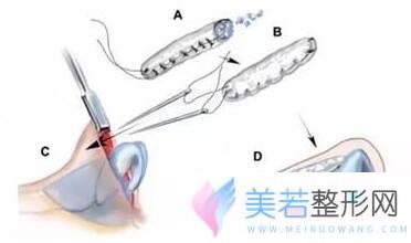 全肋隆鼻