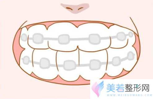 牙齿矫正