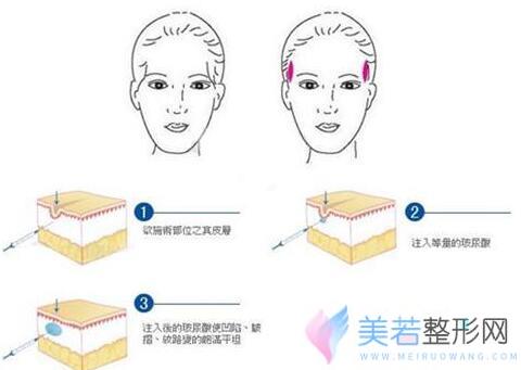 玻尿酸丰太阳穴