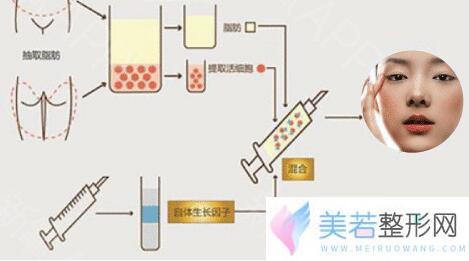 自体脂肪丰太阳穴