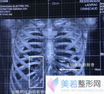 肋软骨钙化情况