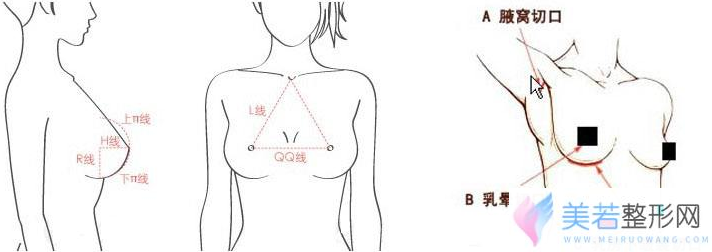 假体隆胸切口位置