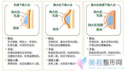 假体隆胸假体放置位置