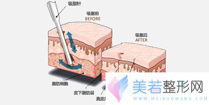 吸脂瘦手臂