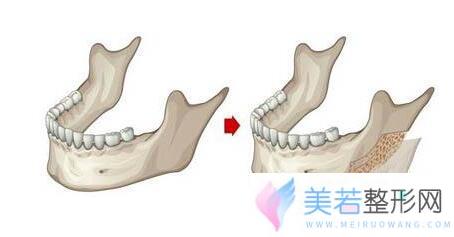 下颌角整形
