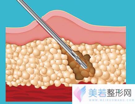 光纤溶脂