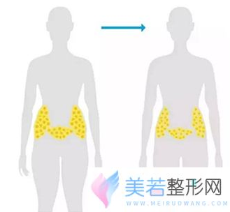 腰腹吸脂的前后对比图