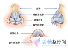 鼻骨内推术后太窄可以修复吗?