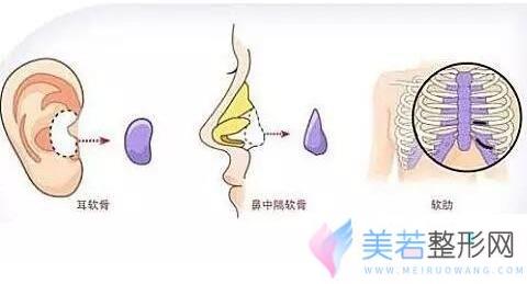 自体软骨隆鼻