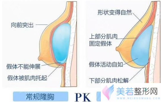 双平面隆胸技术