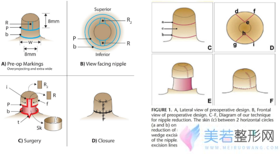 乳头缩小