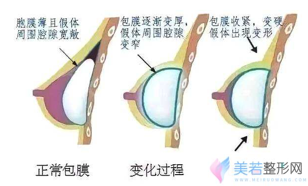 光面假体隆胸