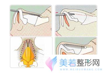 驼峰鼻矫正