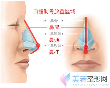 肋软骨隆鼻取肋软骨伤口