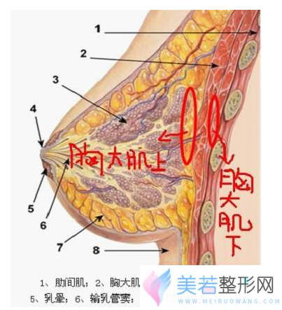 假体隆胸