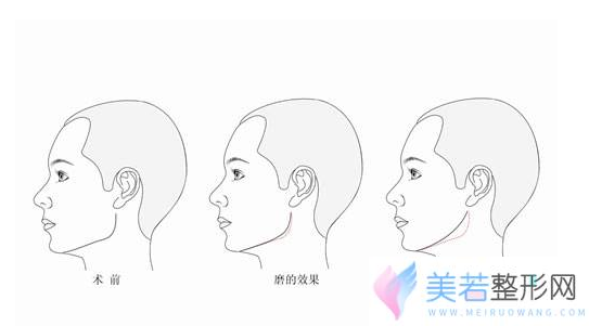 下颌角磨骨